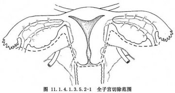 经腹全子宫切除术 