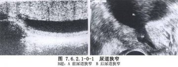 尿道狭窄扩张术 